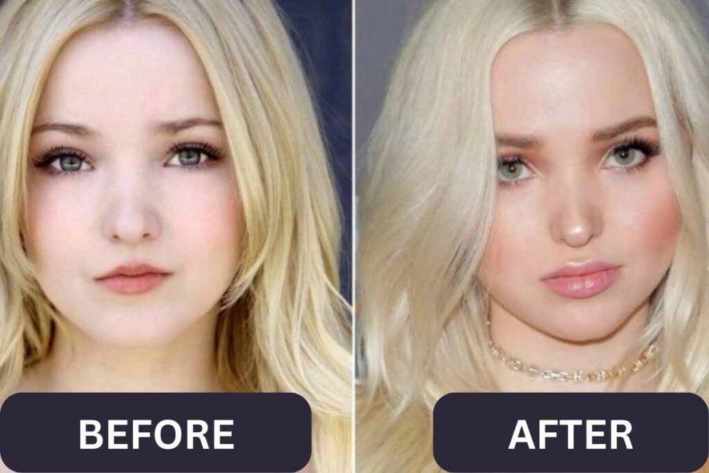 Dove Cameron Before Plastic Surgery Her Transformation Journey!